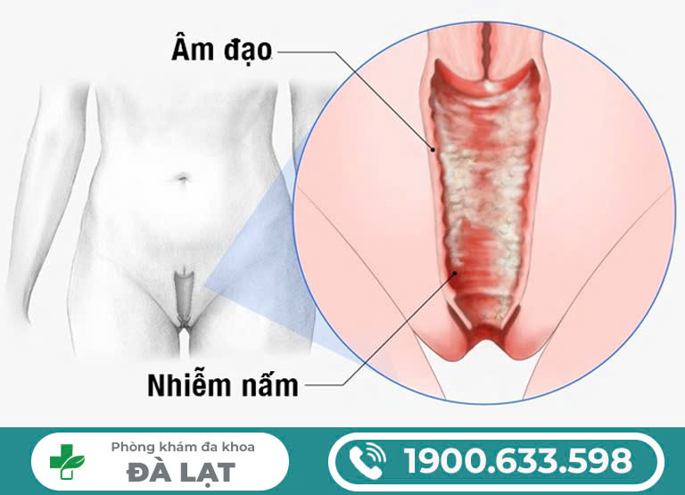 Hình ảnh minh họa