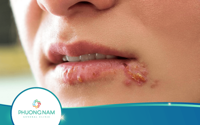 Bệnh Giang Mai Khám Ở Đâu Tại Đà Lạt Uy Tín, Chất Lượng?
