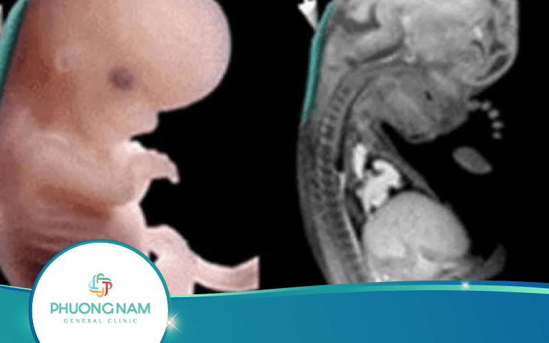 Siêu Âm 12 Tuần Đã Biết Trai Hay Gái Chưa?