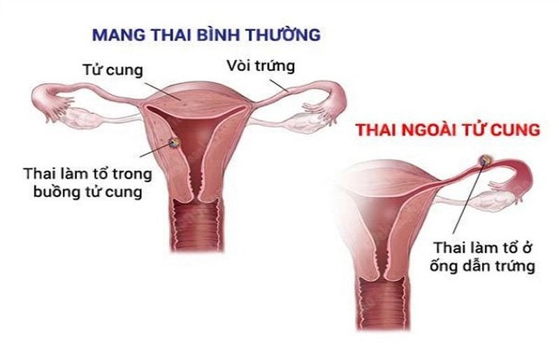 sieu-am-khong-thay-thai